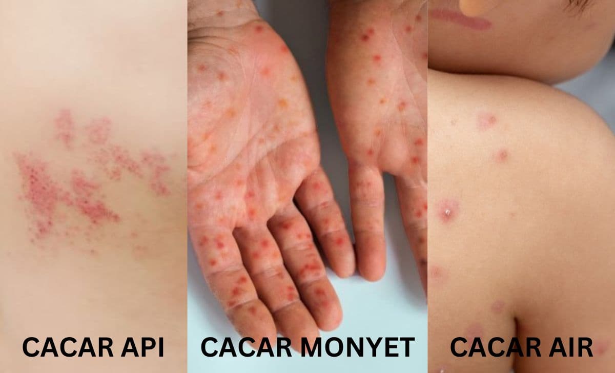 Ungkap Apa Perbedaan Cacar Air, Api, dan Cacar Monyet