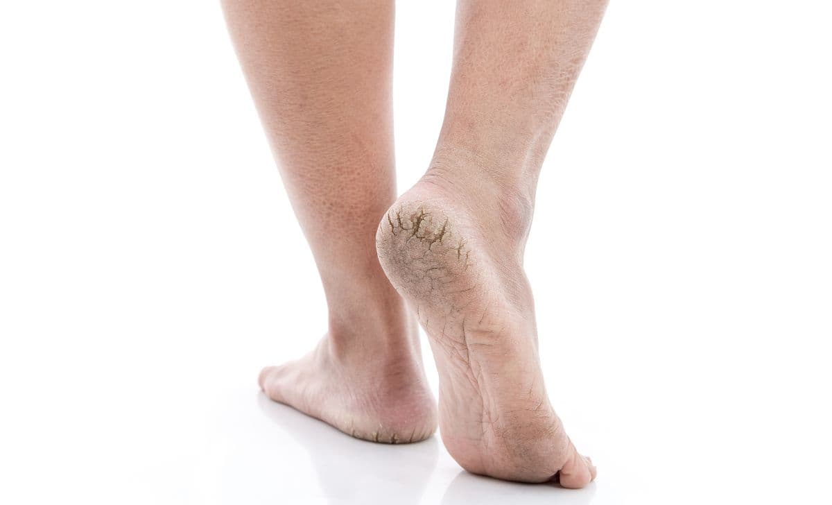 Cara Mengatasi Kaki Pecah-Pecah: Kaki Kembali Halus!