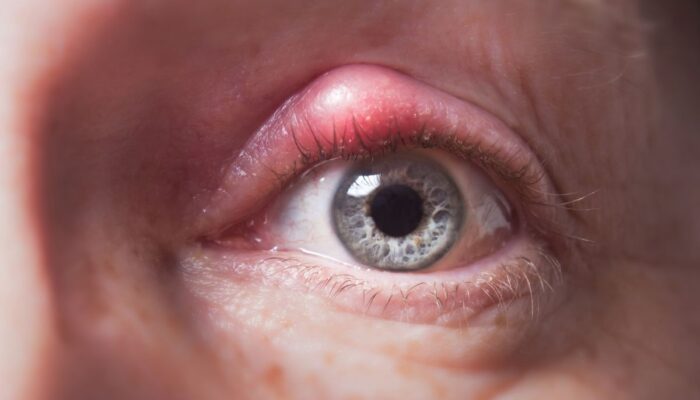 Cara Mengatasi Mata Bintitan: Trik Ampuh dan Mudah!