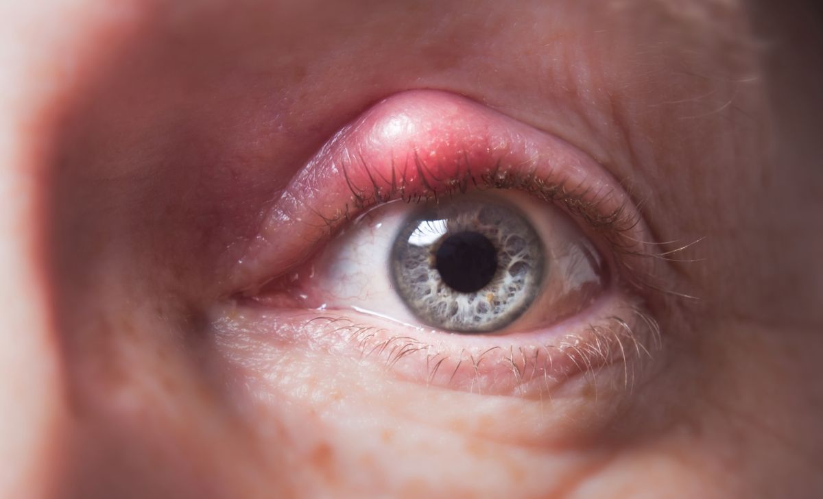 Cara Mengatasi Mata Bintitan