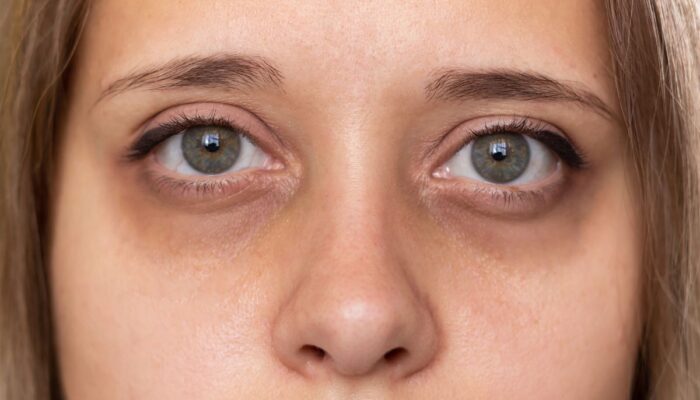 Ampuh! Begini Cara Mengatasi Mata Panda