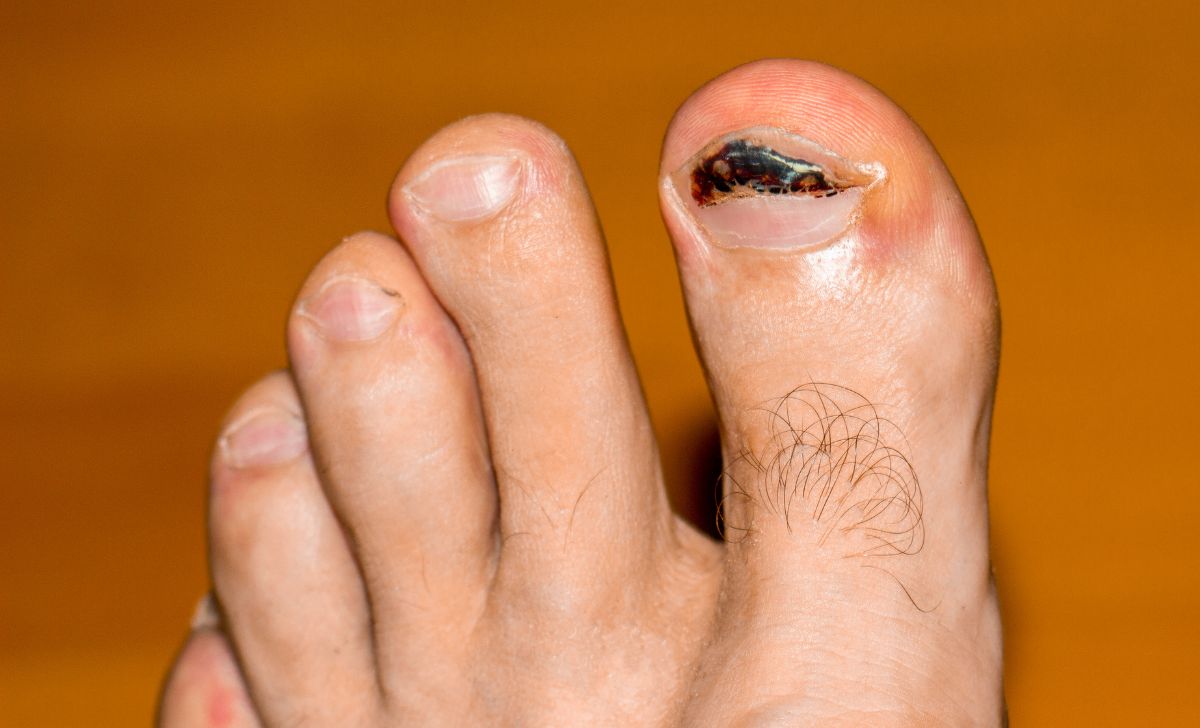 cara mengatasi cantengan