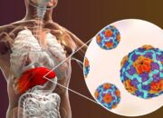 Mengenal Penyakit Hepatitis dan Cara Pencegahannya