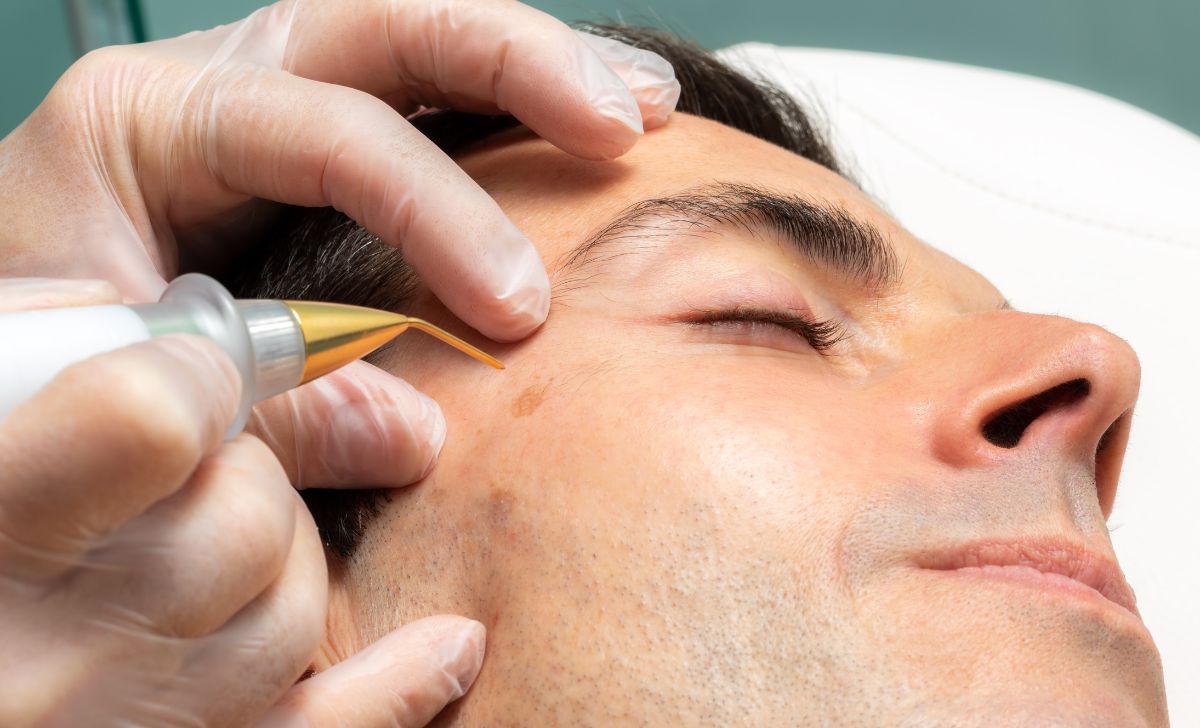 Cara Menghilangkan Kutil