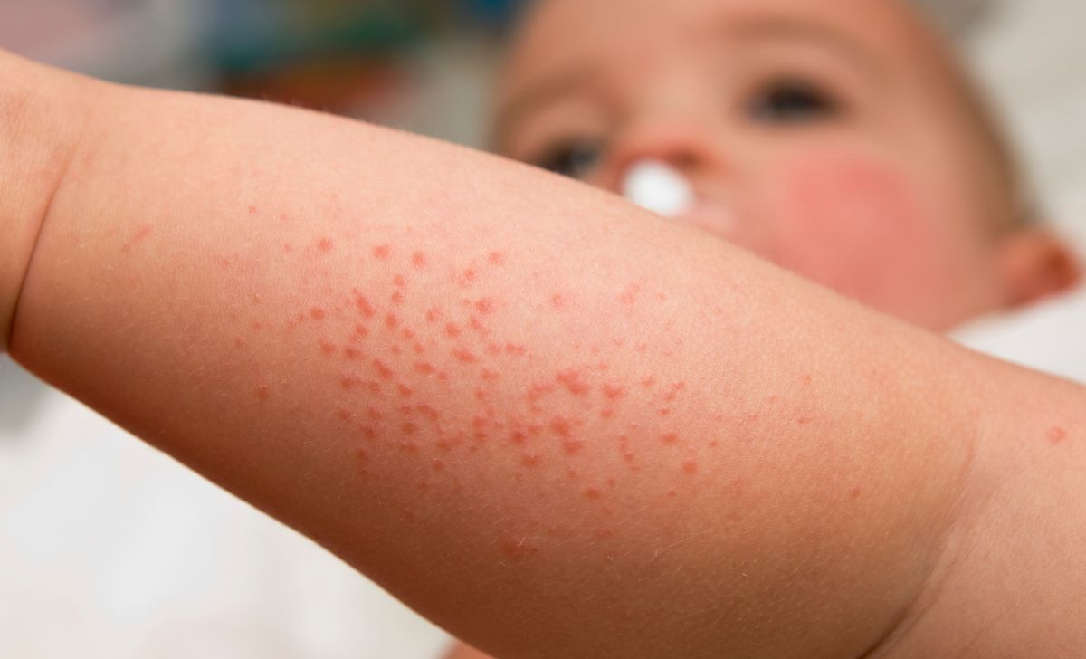 Cara Mengatasi Biang Keringat pada Bayi