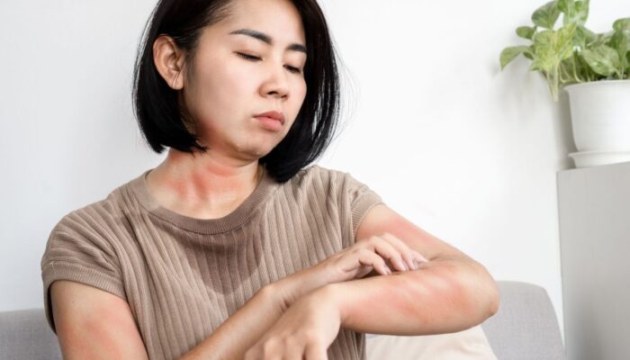 Tips Ampuh! Cara Mengatasi Biduran di Malam Hari