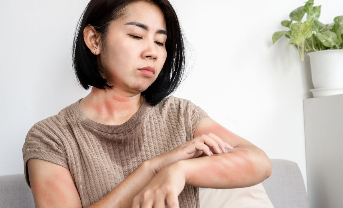 Cara Mengatasi Biduran di Malam Hari