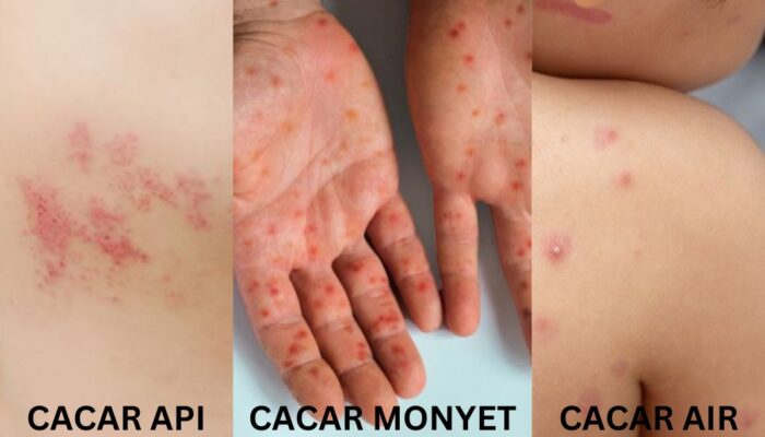 Ungkap Apa Perbedaan Cacar Air, Api, dan Cacar Monyet