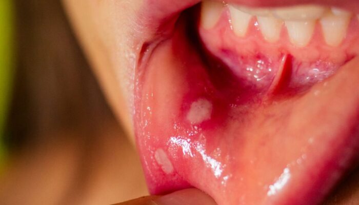 Kenapa Sariawan Terus Muncul? Ungkap Penyebabnya dan Cara Menghindarinya!