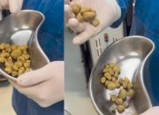 Dokter Peringatkan Bahaya Minuman Bersoda: 35 Batu Dikeluarkan dari Kandung Kemih Pasien