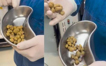 Dokter Peringatkan Bahaya Minuman Bersoda 35 Batu Dikeluarkan dari Kandung Kemih Pasien