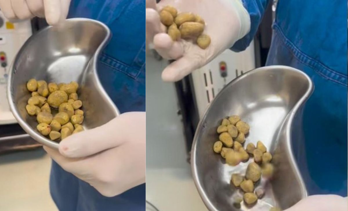 Dokter Peringatkan Bahaya Minuman Bersoda 35 Batu Dikeluarkan dari Kandung Kemih Pasien