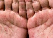 Waspada Sifilis: Penyakit Menular Seksual yang Bisa Menyerang Siapa Saja