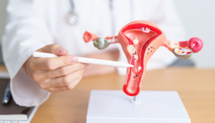 Waspada! Inilah Ciri Ciri Kista Ovarium yang Harus Kamu Tahu