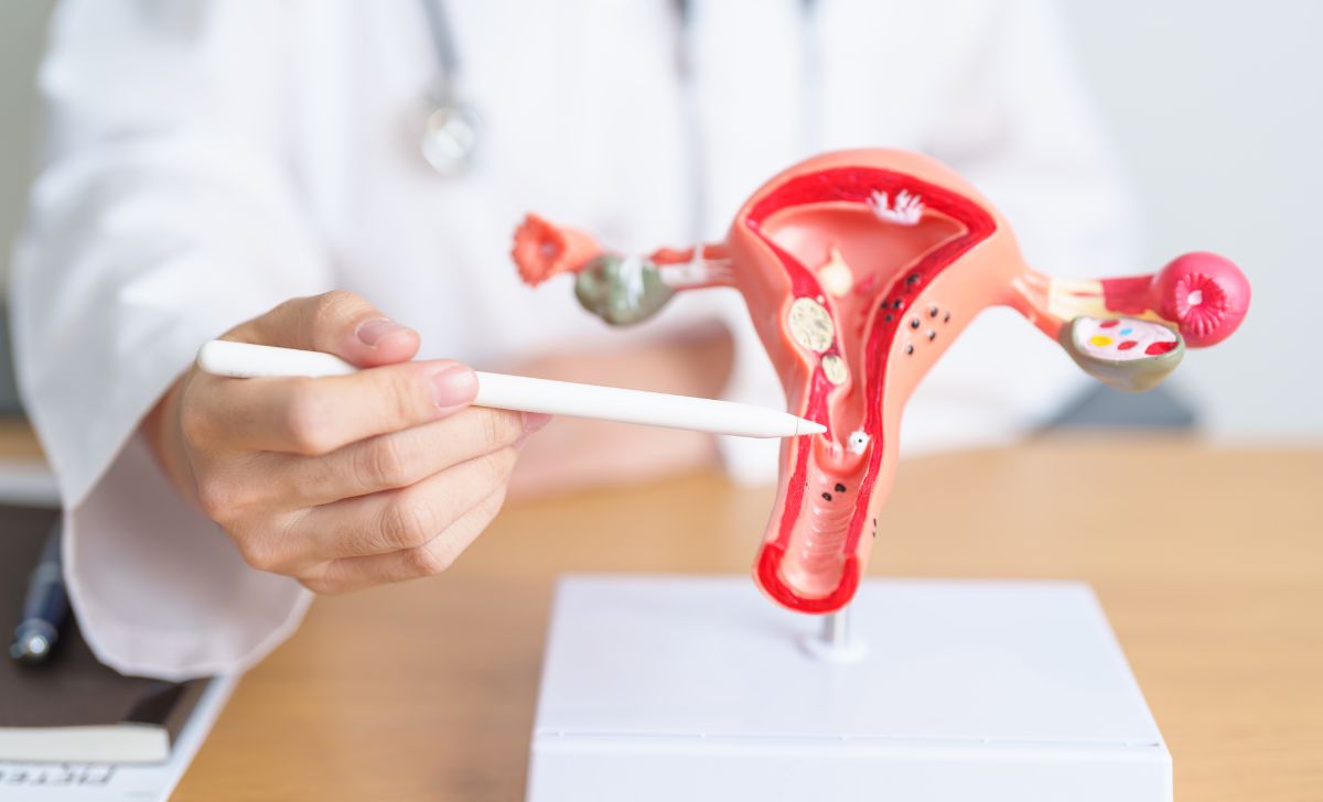 Ciri Ciri Kista Ovarium